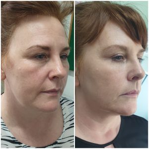 Full facial Rejuvenation