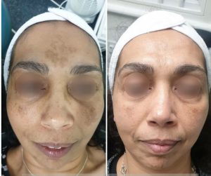 Medical Microneedling (1)